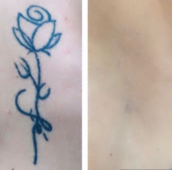 Exemplo de resultado de remoção de tatuagem